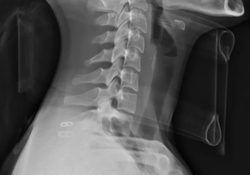 Pluripotent stem cells aid partial motor recovery in spinal cord injury patients