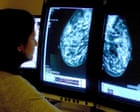 Extra cancer scans for women with dense breasts could save 700 lives a year – UK study