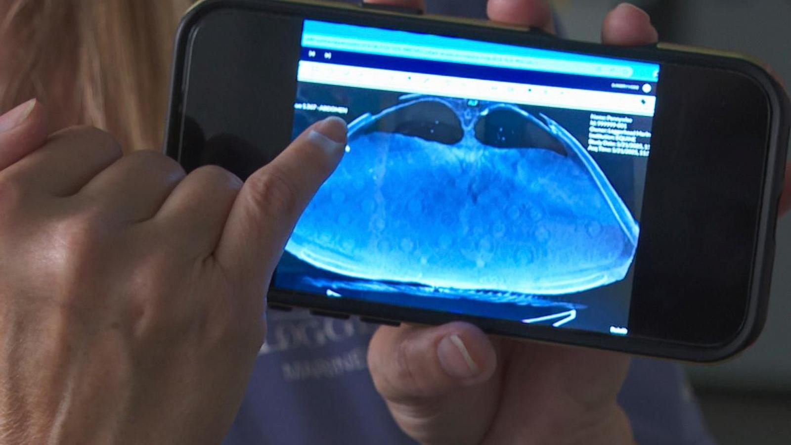 302-pound loggerhead sea turtle hit by boat gets oversized CT scan, with a surprise