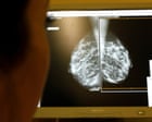 AI use in breast cancer screening cuts rate of later diagnosis by 12%, study finds
