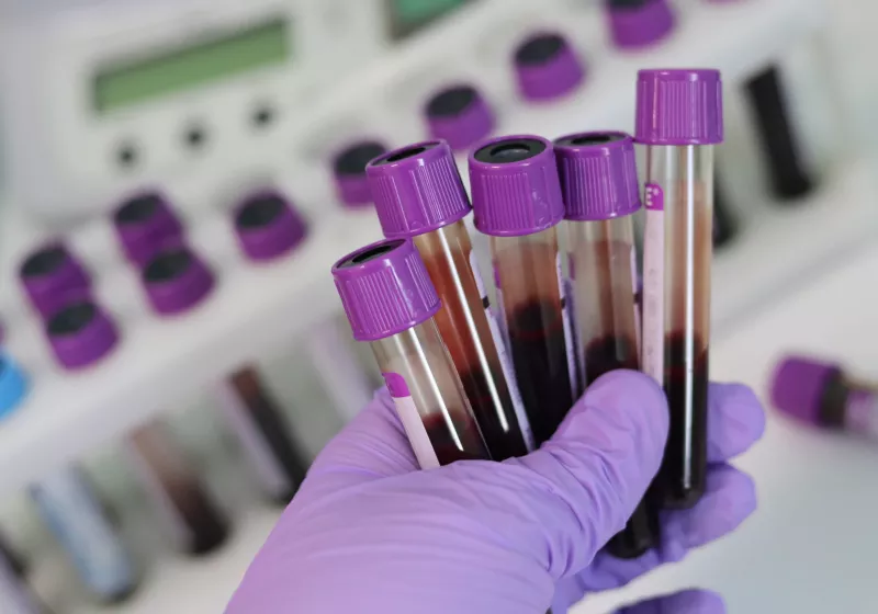 Simple blood test could dramatically boost Alzheimer's diagnosis accuracy