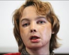 The ‘guinea pigs’ who had face transplant surgery – podcast