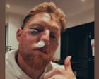 ‘You should see the cricket ball’ jokes Ben Stokes after being struck in the face