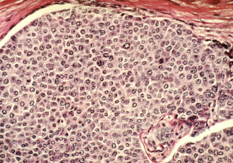This startup wants to destroy cancer tumors using ultrasound instead of surgery