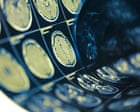 Lacunar strokes caused by widening of arteries in brain, study suggests