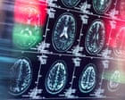 Antidepressants and antipsychotics could serve as alternatives to opioids, study finds